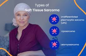 soft tissue sarcoma everything you
