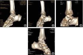 What was missed on the initial ankle films? Pathoanatomy And Injury Mechanism Of Typical Maisonneuve Fracture He Orthopaedic Surgery Wiley Online Library