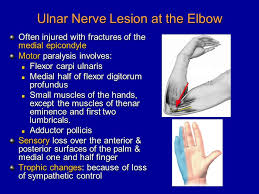 Medial epicondyle fractures represent almost all epicondyle fractures and occur when there is avulsion of the medial epicondyle. Image Result For Ulnar Nerve Palsy Ulnar Nerve Nerve Palsy Nerve