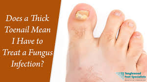 does a thick toenail mean i have to