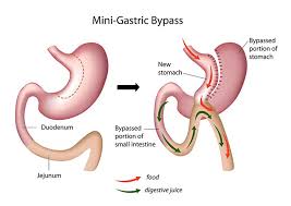 mini gastric byp surgery benefits