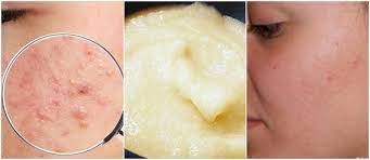 10 home remes to remove dark spots