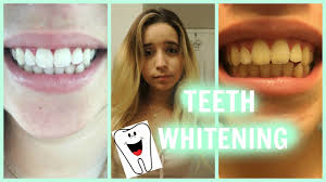 teeth whitening tutorial philips zoom