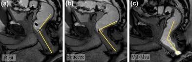 dynamic pelvic floor mri