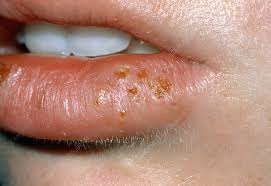 cold sores due to herpes simplex type i