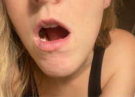 vein inside bottom lip treatable photo