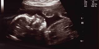 Biasanya parents akan ditunjukkan gambar hasil sementara untuk mengetahui bayi perempuan, biasanya dokter akan mencari tanda seperti hamburger karena klitoris berada di antara bibir vagina (labia). Cara Membaca Hasil Usg Di Trimester Ketiga
