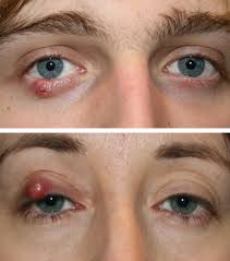 eyelid cysts eyelid surgery centre