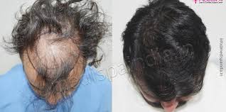 hair transplant in canberra australia