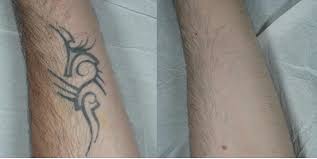 This method would help break down the ink into small fragments. Laser Tattoo Removal Results And Issues The Pmfa Journal