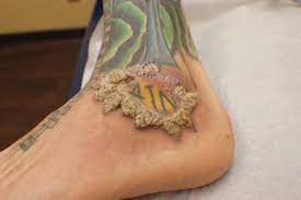 If you have an existing skin condition, getting a tattoo can potentially exacerbate it. Verruciform Plaques Within A Tattoo Of An Hiv Positive Patient Mdedge Dermatology