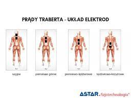 Prądy Traberta (Ultra Reiz)– metodyka, wskazania, przeciwwskazania -  Fizjotechnologia