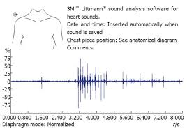 Spectral Analysis Of Bowel Sounds In Intestinal Obstruction