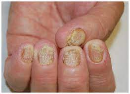 nail disease in patients with psoriasis