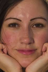 warm red or rosy cheeks causes and