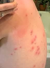 Folliculitis or hot tub rash as it is also known as a common problem. A Bacterial Rash From A Hot Tub I Am So Intensely Skeeved Out I Can Barely Function When I Look At It Trypophobia
