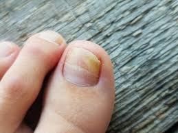 nail diseases in bwood tn