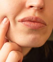 what are the diffe cold sore triggers