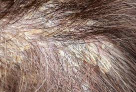 seborrheic dermais and hair loss