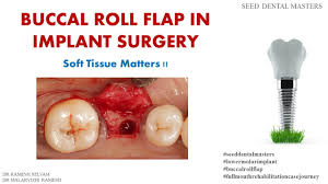 buccal roll flap in implant surgery