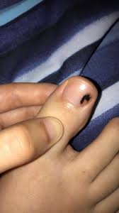 black area on toenail nail disorders