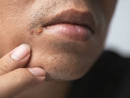 herpes scars causes prevention and