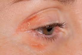 psoriasis on the eyelids symptoms