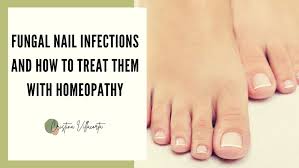homeopathic remedy for toenail fungus