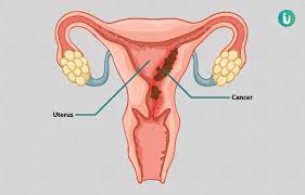 All you need to know. à¤¬à¤š à¤š à¤¦ à¤¨ à¤—à¤° à¤­ à¤¶à¤¯ à¤® à¤• à¤¸à¤° à¤• à¤²à¤• à¤·à¤£ à¤• à¤°à¤£ à¤‡à¤² à¤œ à¤¦à¤µ à¤‰à¤ªà¤š à¤° à¤¡ à¤• à¤Ÿà¤° Endometrial Cancer Symptoms Causes Treatment Doctor Medicine Prevention In Hindi