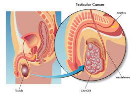 Testicular cancers are the most common neoplasm in men between the ages of 20 and 34 years. Identify Testicular Cancer Symptoms University Health News
