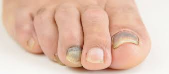 thickened and discoloured toenails
