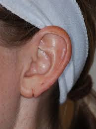 earlobe repair houston torn earlobe