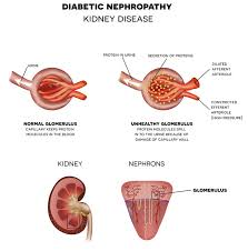 Nephropathy A Complication Of Diabetes