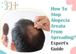 stop alopecia areata from spreading
