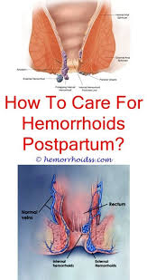 Thrombosis can occur in internal and external hemorrhoids. What Does A Thrombosed External Hemorrhoid Look Like Is Sitting Or Standing Better For Hemorrhoi Cure For Hemorrhoids Bleeding Hemorrhoids Hemorrhoid Remedies