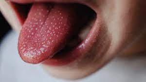 big tongue macroglossia symptoms