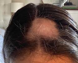 This will reduce bald spots and prevent flattening of the back of the head, although neither of these is harmful. Amazing Regrowth I Had To Show You All Little Pouf Of White Baby Hair Can T Wait For It To Turn Dark Alopecia Areata