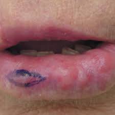 nontender nodules on the lower lip