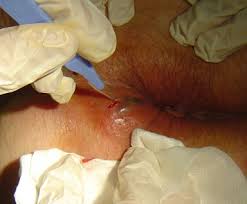 treatment of fistula and abscess