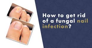 how to get rid of a fungal nail