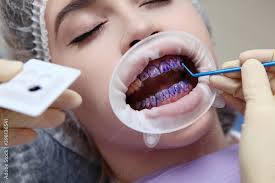The dentist applies the tooth of a purple gel on the patient's teeth prior  to a professional dental cleaning. Prevention of caries and gum diseases.  Hands in protective gloves. Macro photo. Stock