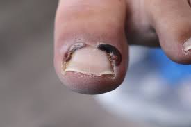 untreated toenail fungus