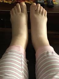 severely swollen feet ankles legs 4