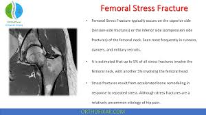 fem stress fracture orthofixar 2023