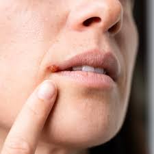 1 unexpected cause of cold sores