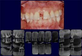 periodontal treatment methods fort lee