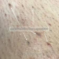 ingrown hair causes and how to treat