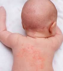 baby heat rash what is it causes and