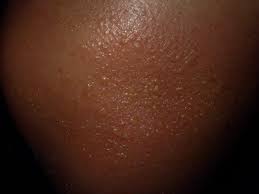 White people, on the other hand, had the highest rates of sunburn. Pictures Of Sunburn On Black Skin