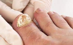 can toenail fungus spread through nail